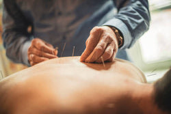 Acupuncture for Anxiety and Depression: Learn How It Works