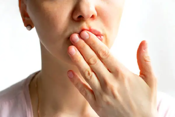 Torn Corners of the Mouth | Just annoying or Dangerous?