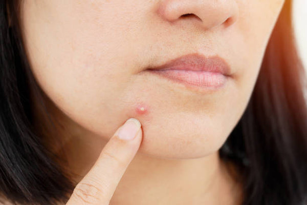 How to reduce inflammation of a pimple in any area of the body